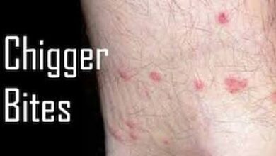 Chigger Bites